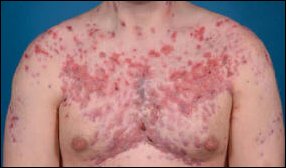 Back acne due to steroids