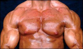 Extreme acne door anabolen tekent bodybuilder (21) voor het leven