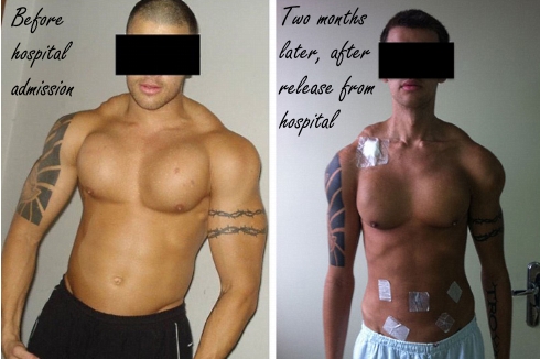 Een bodybuilder, injecteerbare vitamines, kapotte nieren en dertig kilo spieren