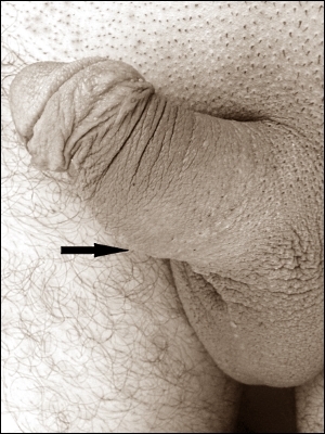 Abces in penis na tien jaar anabolengebruik