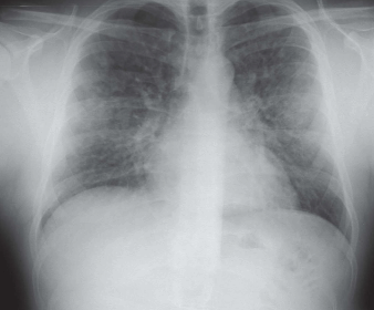 Is primobolan slecht voor de longen?