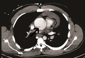 Anabolengebruiker scheurt aorta