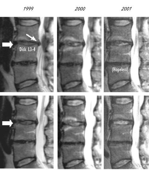 Beschadigde tussenwervelschijf herstelt door glucosamine en chondroitin