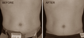 Laserbehandeling vervangt liposuctie