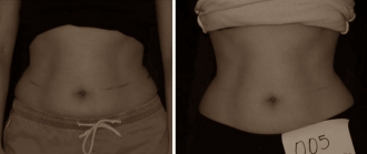 Laserbehandeling vervangt liposuctie