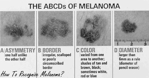 Suppletie met B-vitamines halveert kans op agressieve vorm huidkanker