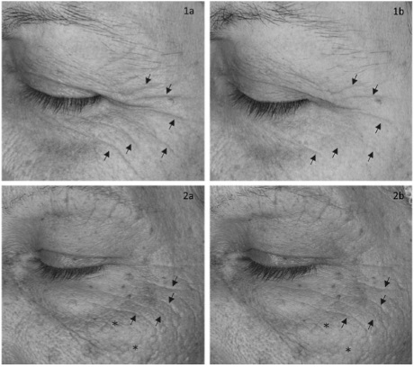 Q10 bestrijdt rimpels