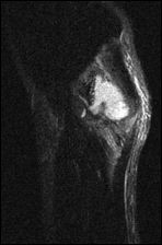 Bodybuilder krijgt gezwel in triceps na injectie met anabolen