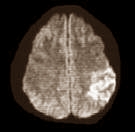 Van de neurologen van Indiana University mag de overheid alle afslanksupplementen met Ephedra uit de schappen halen. De cocktails van thermogene stoffen veroorzaken beroertes met vaak blijvende gevolgen. Dat blijkt uit vijf gevallen die de artsen de afgelopen twee jaar in hun ziekenhuis zagen langskomen.