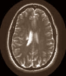 Van de neurologen van Indiana University mag de overheid alle afslanksupplementen met Ephedra uit de schappen halen. De cocktails van thermogene stoffen veroorzaken beroertes met vaak blijvende gevolgen. Dat blijkt uit vijf gevallen die de artsen de afgelopen twee jaar in hun ziekenhuis zagen langskomen.