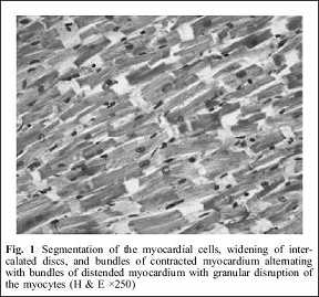 Sudden cardiac death during anabolic steroid abuse: morphologic and toxicologic findings in two fatal cases of bodybuilders