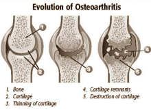 Krachttraining en creatine verzachten osteoartritis