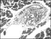 Sudden anabolic steroid abuse-related death in athletes
